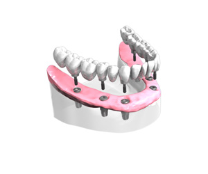 Remplacer toutes les dents absentes ou abîmées - Dentiste Saint Marcellin