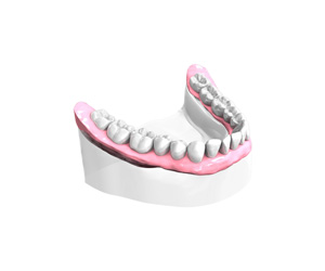 Remplacer plusieurs dents absentes ou abîmées - Dentiste Saint Marcellin